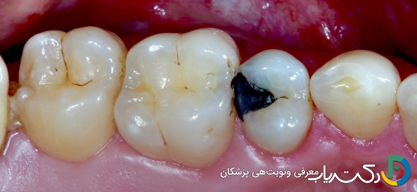 چه مشکلاتی ممکن است پس از ترمیم دندان پیش آید؟