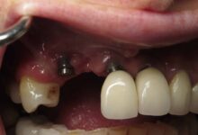 چه کارهایی نباید بعد از ایمپلنت دندان انجام داد؟