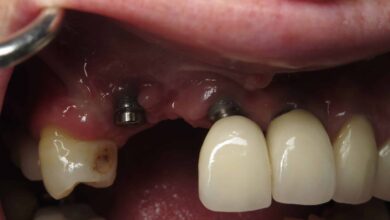 چه کارهایی نباید بعد از ایمپلنت دندان انجام داد؟