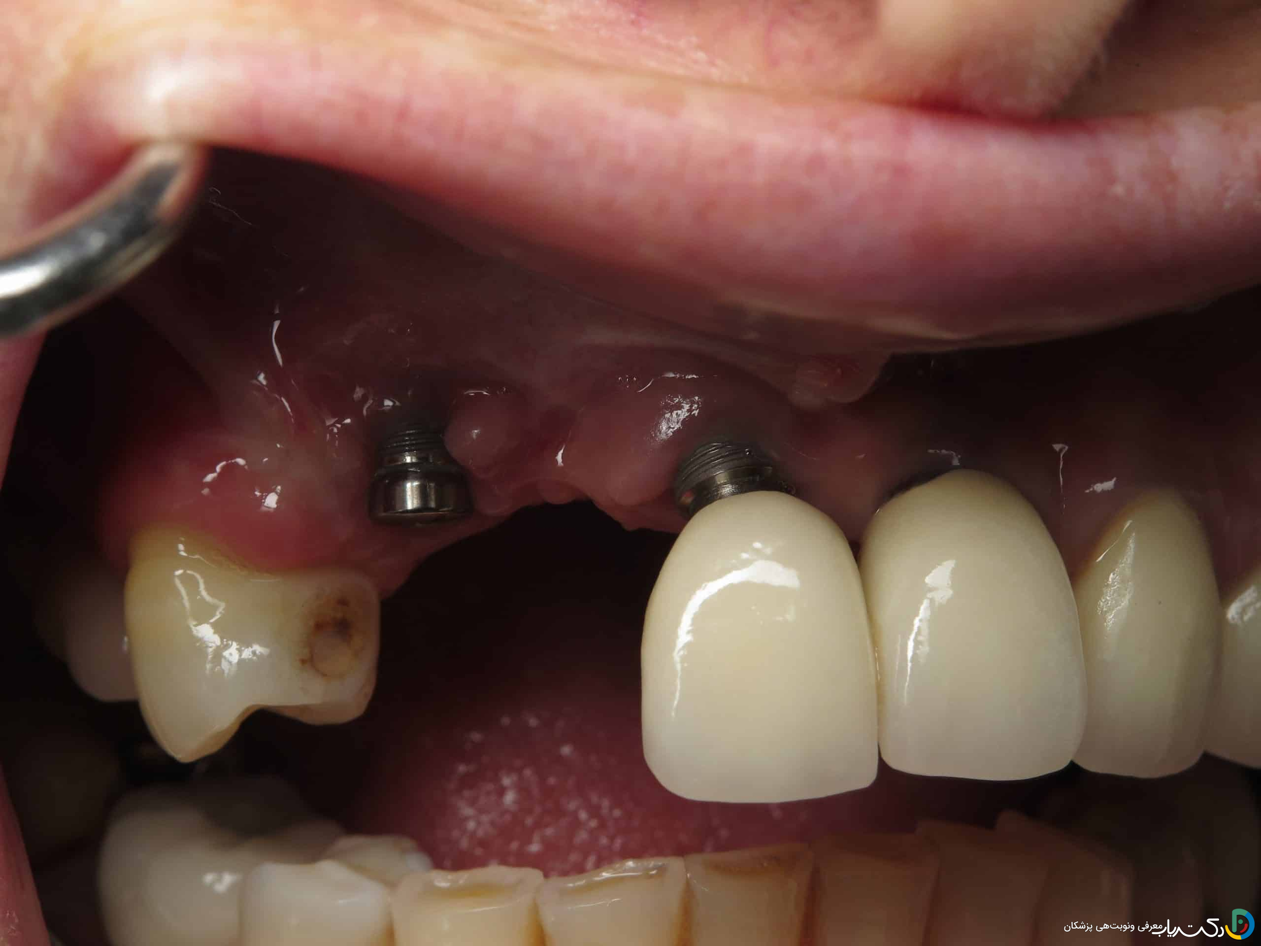 چه کارهایی نباید بعد از ایمپلنت دندان انجام داد؟