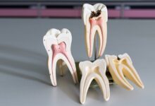 چه کارهایی نباید بعد از عصب کشی دندان انجام دهیم؟