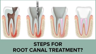 چه مراحلی در طی عصب کشی دندان انجام می شود؟