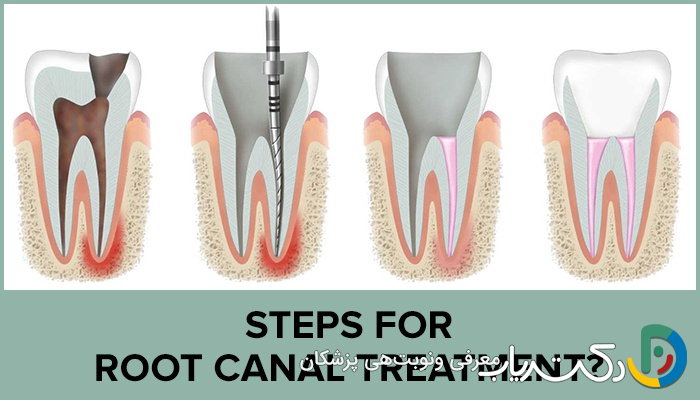 چه مراحلی در طی عصب کشی دندان انجام می شود؟