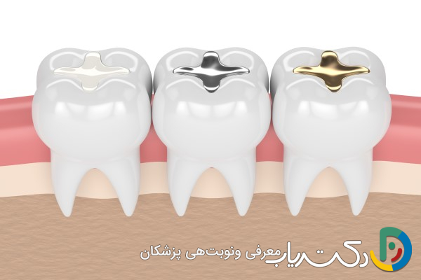 چه نوع مواد پرکننده برای ترمیم دندان استفاده می شود؟