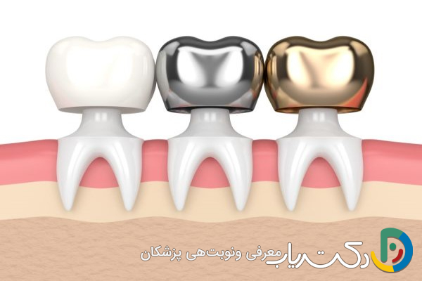 چه نوع موادی برای ساخت روکش دندان استفاده می شود؟