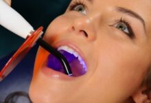 چه زمانی باید برای کامپوزیت دندان اقدام کنیم؟