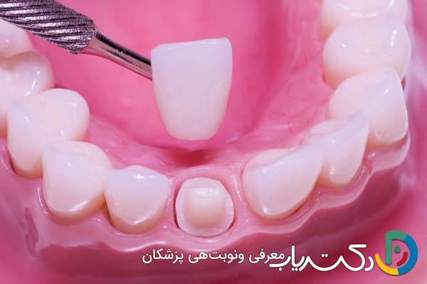 چه زمانی باید برای روکش دندان اقدام کرد؟