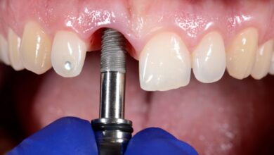 چه زمانی باید برای ایمپلنت دندان اقدام کرد؟