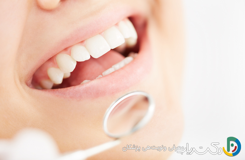 چه زمانی باید برای بلیچینگ دندان اقدام کرد؟