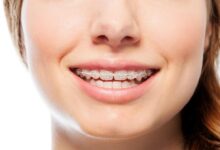 چه زمانی باید برای ارتودنسی اقدام کرد؟