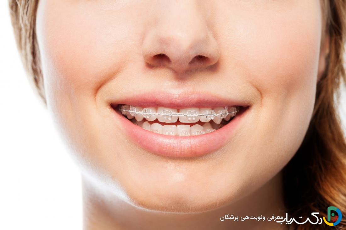 چه زمانی باید برای ارتودنسی اقدام کرد؟