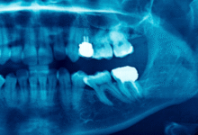 چه زمانی باید برای عصب کشی اقدام کرد؟