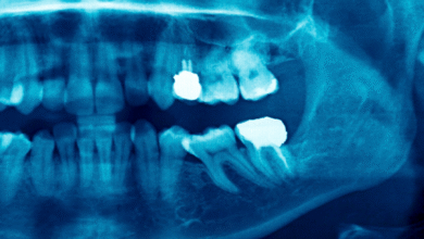چه زمانی باید برای عصب کشی اقدام کرد؟