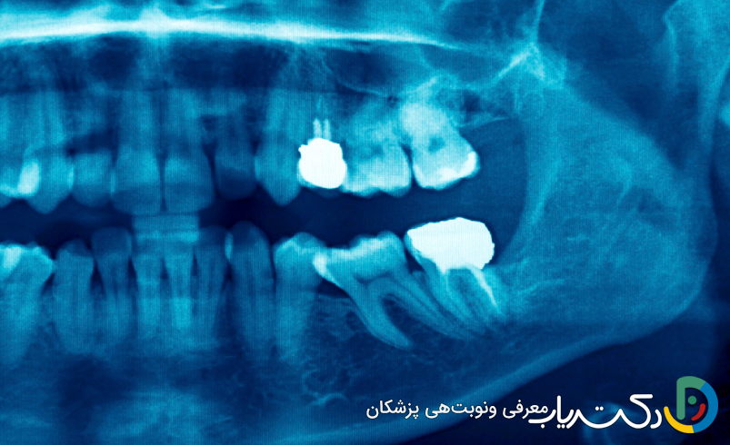 چه زمانی باید برای عصب کشی اقدام کرد؟