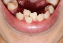 چه افرادی به ارتودنسی نیاز دارند؟