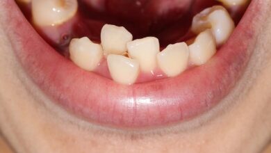 چه افرادی به ارتودنسی نیاز دارند؟