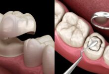 چرا روکش دندان در مقایسه با پرکردگی بهتر است؟