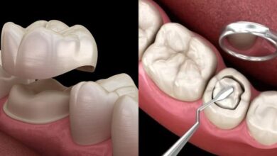 چرا روکش دندان در مقایسه با پرکردگی بهتر است؟