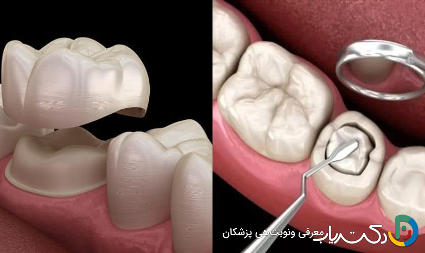 چرا روکش دندان در مقایسه با پرکردگی بهتر است؟