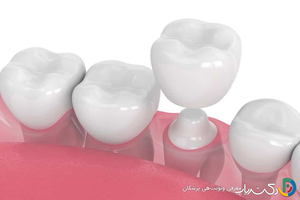 چرا روکش دندان برای دندان های آسیب دیده ضروری است؟