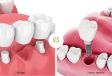 چرا ایمپلنت دندان بهتر از بریج است؟