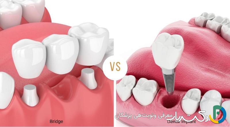 چرا ایمپلنت دندان بهتر از بریج است؟