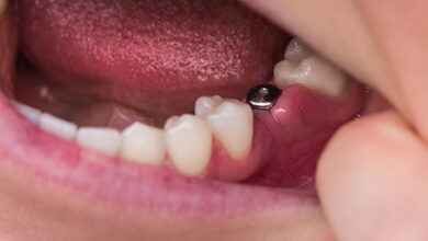چرا در برخی کشورها ایمپلنت دندان ارزان تر است؟