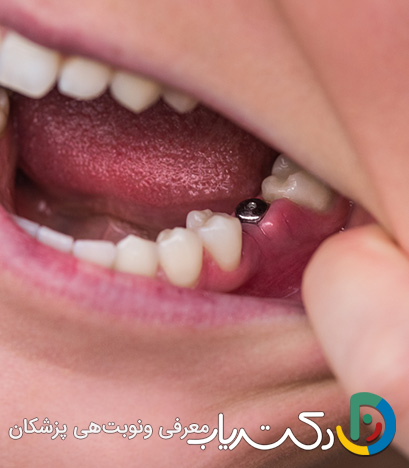 چرا در برخی کشورها ایمپلنت دندان ارزان تر است؟