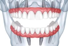 چرا ایمپلنت دندان در کشورهای مختلف هزینه های متفاوتی دارد؟