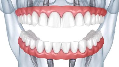 چرا ایمپلنت دندان در کشورهای مختلف هزینه های متفاوتی دارد؟