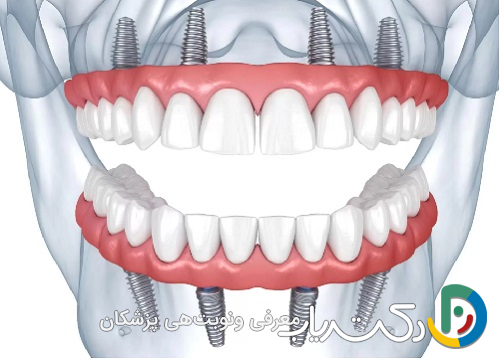 چرا ایمپلنت دندان در کشورهای مختلف هزینه های متفاوتی دارد؟