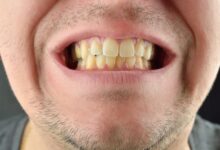 چرا دندان ها به مرور زمان زرد می شوند؟
