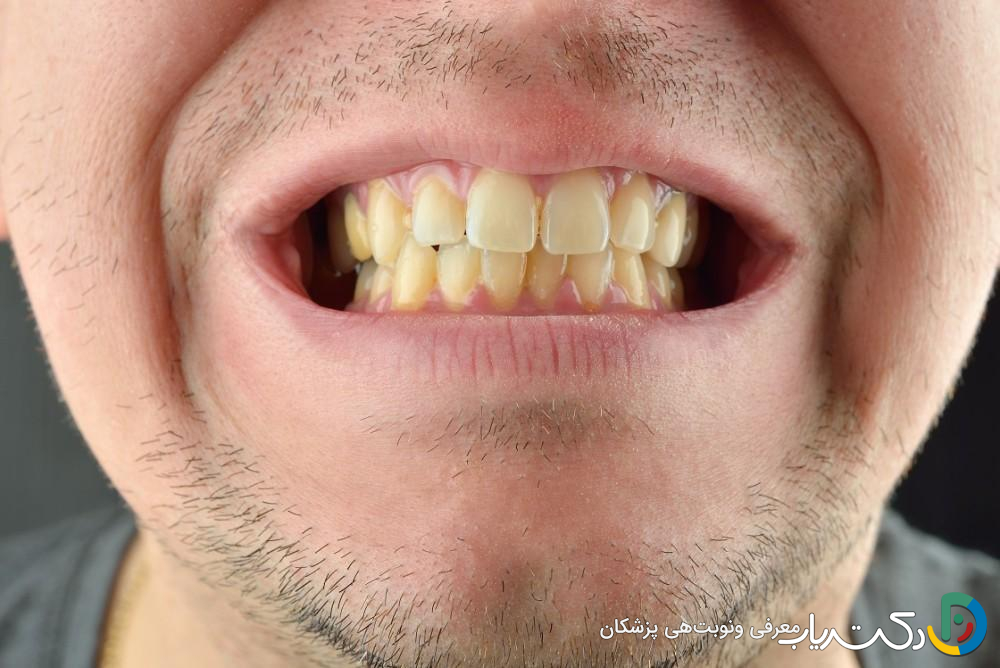 چرا دندان ها به مرور زمان زرد می شوند؟