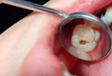 چرا عصب کشی دندان ضروری است؟