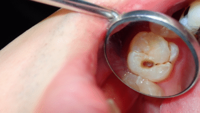 چرا عصب کشی دندان ضروری است؟