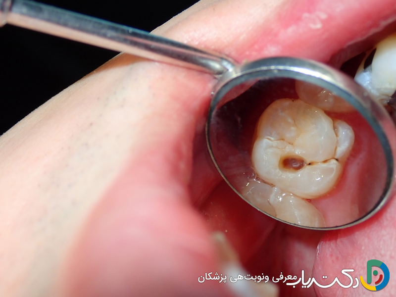 چرا عصب کشی دندان ضروری است؟