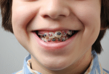 چرا ارتودنسی بهترین روش برای اصلاح دندان های کج است؟