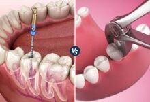 چرا عصب کشی دندان بهتر از کشیدن دندان است؟