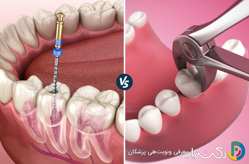چرا عصب کشی دندان بهتر از کشیدن دندان است؟