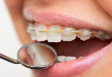 چرا ارتودنسی ممکن است برای برخی افراد مؤثر نباشد؟