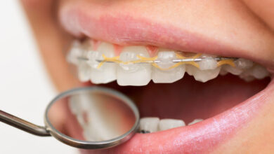 چرا ارتودنسی ممکن است برای برخی افراد مؤثر نباشد؟