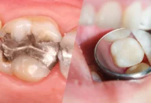 چه تفاوتی بین کامپوزیت دندان و پرکردگی های دیگر وجود دارد؟