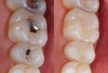 چه تفاوتی بین ترمیم دندان و سایر درمان ها وجود دارد؟