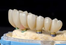 چه تفاوت هایی بین ترمیم دندان و روش های دیگر مانند ایمپلنت یا بریج