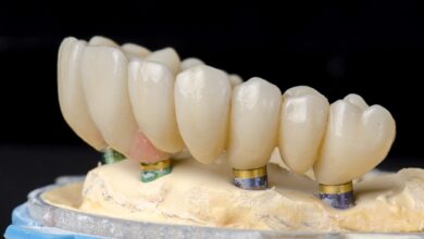 چه تفاوت هایی بین ترمیم دندان و روش های دیگر مانند ایمپلنت یا بریج