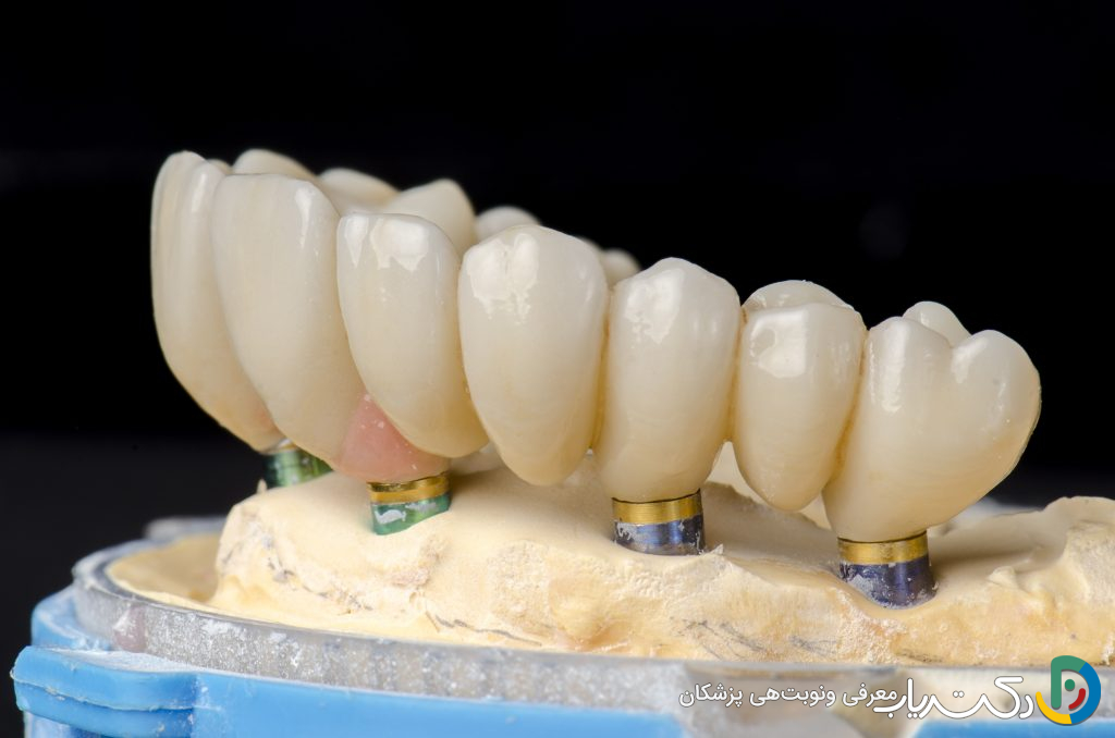 چه تفاوت هایی بین ترمیم دندان و روش های دیگر مانند ایمپلنت یا بریج