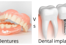 چه تفاوتی بین دندان مصنوعی و ایمپلنت دندان وجود دارد؟