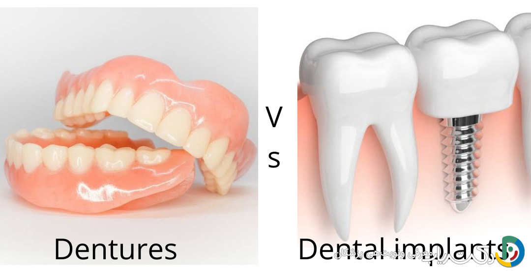 چه تفاوتی بین دندان مصنوعی و ایمپلنت دندان وجود دارد؟