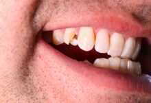 آیا عصب کشی برای دندان های آسیب دیده از ضربه مناسب است؟