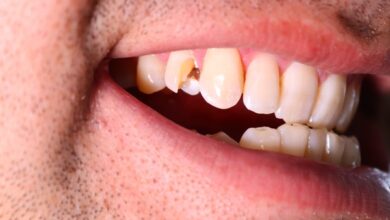 آیا عصب کشی برای دندان های آسیب دیده از ضربه مناسب است؟